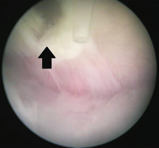 TRUS-guided needle aspiration of a prostatic abscess is indicated for young patients and moribund patients [11].