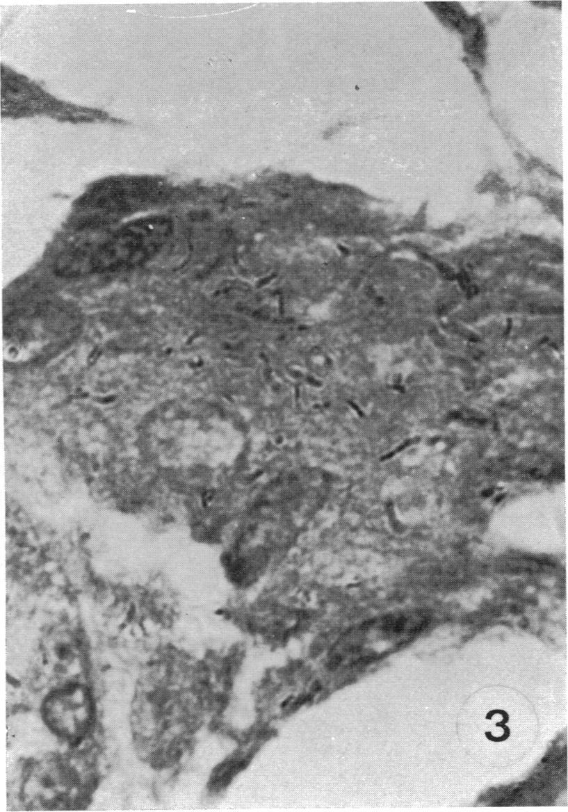 41, Fig. 3. CCB test in an LL patient showing a negative result at 30 days.