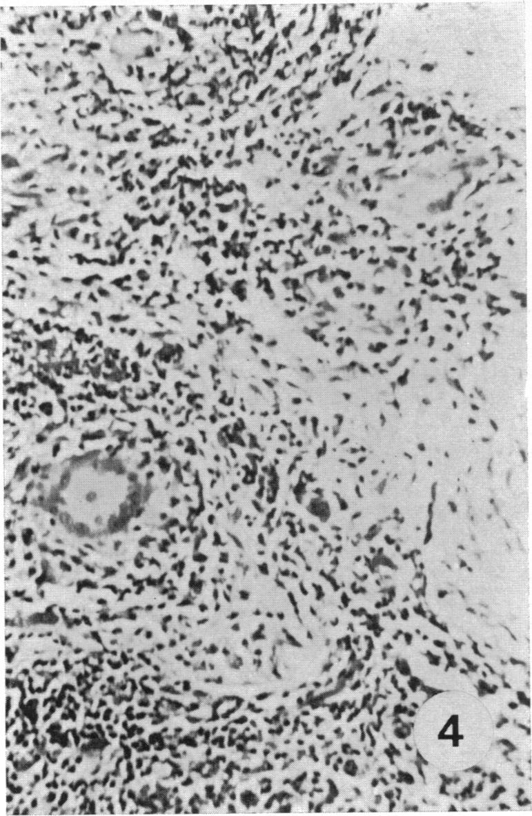 CCB test for M. Ieprae in a TL patient positive at 30 days. The granuloma is formed of epithelioid cells and giant cells.