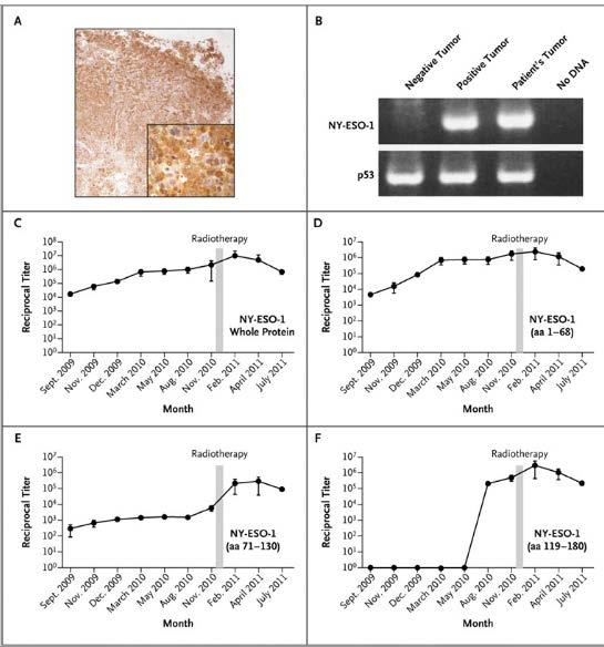 Tumor shrinkage was associated with antibody responses to the antigen NY- ESO-1