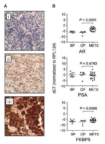 Androgen Insensitive Castration Resistant In a metastatic lymph node from a hormone-refractory patient Androgen