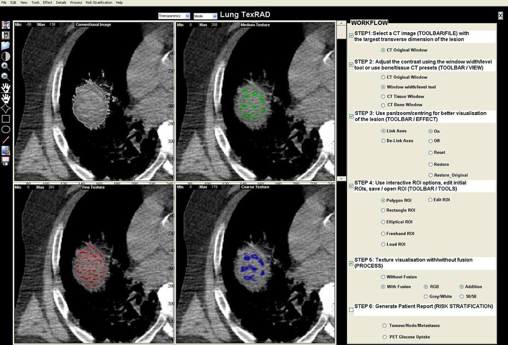 Fig. 2: Highlights the conventional non-contrast CT image of the lung lesion (top-left), followed by the derived lesion texture maps superimposed on the conventional CT image for