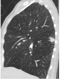 production >5mm invasive component Solid component 2013 2017 Varied appearance Solitary pulmonary nodule large mass
