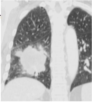RADIOGRAPHIC FEATURES Large heterogeneous mass Usually enhancing Round versus lobulated borders