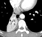 Primitive neuroectodermal tumor Desmoplastic round cell tumor Carcinomas with Rhabdoid Phenotype Paraganglioma
