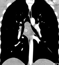 Diffuse Idiopathic Pulmonary Neuroendocrine hyperplasia (DIPNECH) Carcinoids Precursor lesion to pulmonary