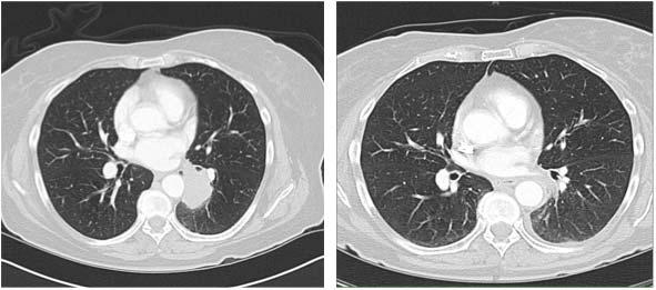 Small Cell Lung Carcinoma (SCLC) Small Cell Lung Cancer (Limited stage)