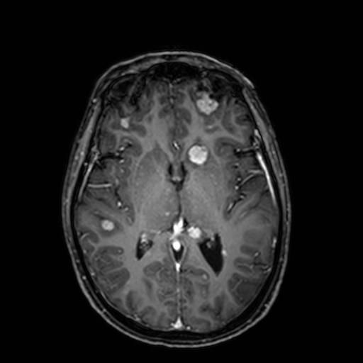 , pre-treated with platinum-pemetrexed and then nivolumab; then brain