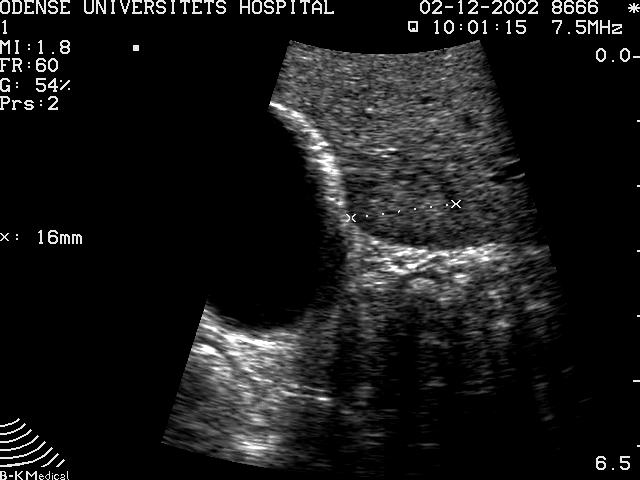 Laparoscopic Ultrasound