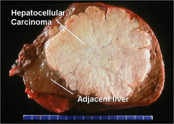 Hepatocellular carcinoma (HCC) The 5th most common cancer worldwide The 3rd leading cause of cancer-related deaths