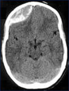 (5) Anticoagulation should be avoided in the presence of active intracranial bleeding, preexisting bleeding