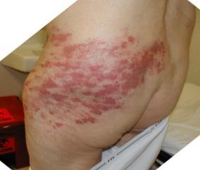 Viral Skin Infections Herpes Zoster Shingles Chronic