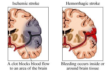 Types of Strokes 3 Major Types 1. Ischemic Stroke 2.