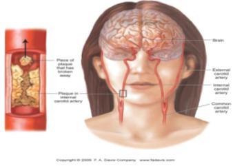 Subarachnoid Hemorrhage Most common type 80% of strokes Usually caused