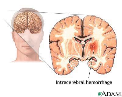 Intracerebral Hemorrhage Sudden rupture of cerebral