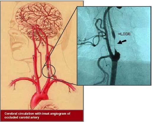 Cerebral Angiography Angiography of the blood vessels of the brain after injection