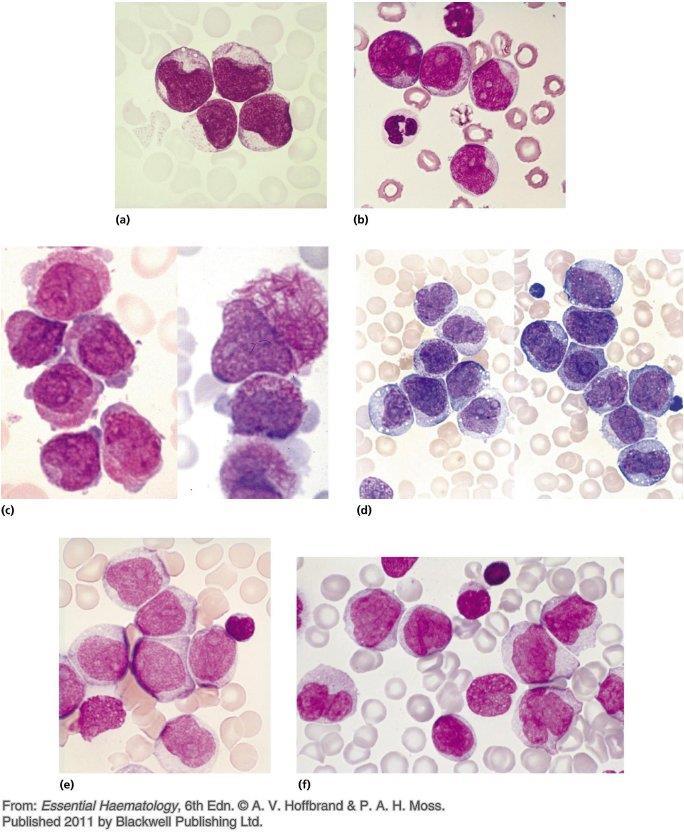 Morphological examples of acute myeloid leukemia.