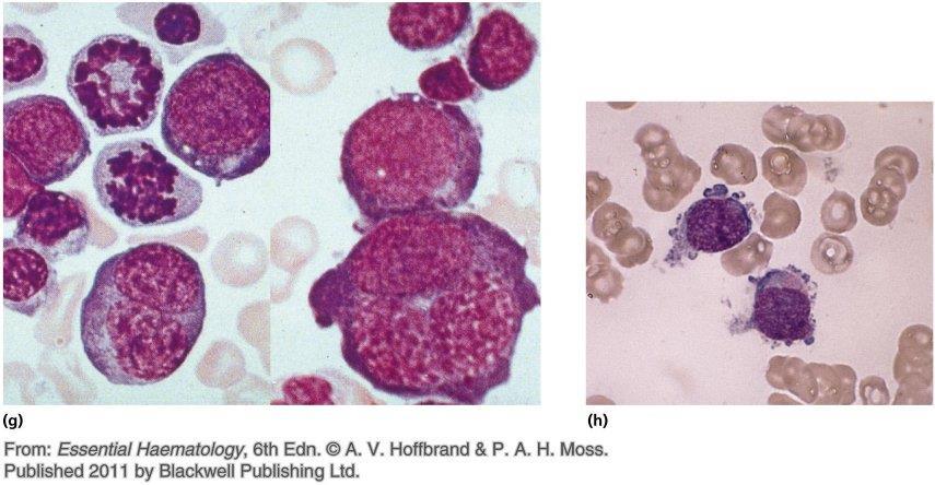 multiple cytoplasmic granules or (c) M 3 blast cells contain prominent granules or multiple Auer rods; (d) myelomonocytic blasts have