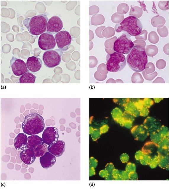 Acute Lymphoblastic Leukemia Morphology, cytochemistry and immunophenotyping of acute lymphoblastic leukemia (ALL). (a) Lymphoblasts show scanty cytoplasm without granules.