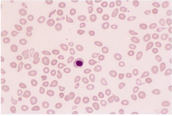part of leukoerythroblastic picture) Essential Thrombocythemia (ET) Left: Peripheral blood film in essential thrombocythemia showing increased numbers of platelets and a nucleated