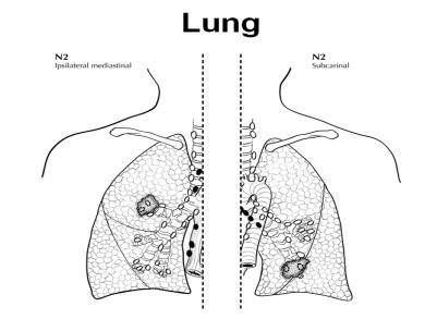 Lung Anatomy Regional Lymph Nodes N2 is defined as metastasis in ipsilateral mediastinal (left side of diagram) and/or
