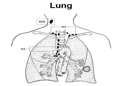 37 Lung Anatomy Regional Lymph Nodes N3 is defined as metastasis in contralateral mediastinal, contralateral hilar,