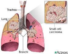 *Small cell lung cancer is less common than nonsmall cell lung cancer *Often grows more quickly *The name is often shortened to