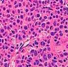 * Bronchioloalveolar (82503)--a very specific subtype adenocarcinoma with a distinct characteristic presentation and behavior. These tumors arise in the alveolar sacs in the lungs.