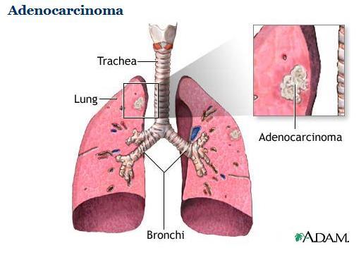 Adenocarcinoma 52 Adenocarcinoma Majority Arises from terminal bronchioles Tend to be located in the periphery of the lung Cancer that begins in the cells that line the alveoli and make substances
