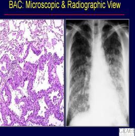adenocarcinoma) http://www.pathologyoutlines.com Bronchoalveolar Adenocarcinoma http://cancergrace.