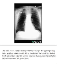 CT 65 Lung Cancer Workup *