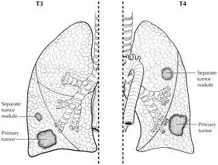 A tumor that extends through the elastic layer is defined as PL1 and one that extends to the surface of the visceral pleural as PL2.