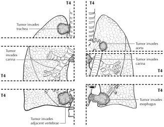 right), trachea (upper left), recurrent laryngeal nerve, esophagus
