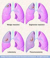 segment Lobectomy Removal of entire lobe of the lung Pneumonectomy Removal of entire