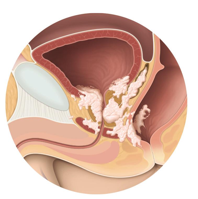 bladder neck rectum tumour urinary sphincter Fig. 2: A T4 prostate tumour which has spread to the bladder neck, urinary sphincter, and rectum.