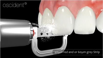 User Manual 1. PURPOSE The strips are used for minimally invasive interdental opening of the interdental space.