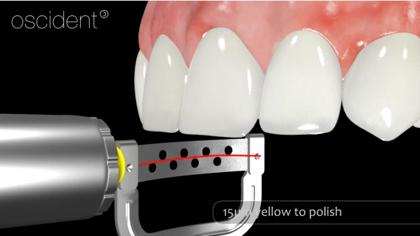 After repeating this procedure at all contact points, remove the still running contra-angle from the interdental gap and oral cavity. Turn off the contra-angle.