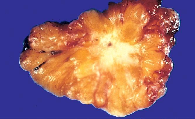 Invasive ductal carcinoma, not otherwise specified Usually is associated with DCIS and, rarely, LCIS Most ductal carcinomas produce a desmoplastic response, which replaces normal breast fat