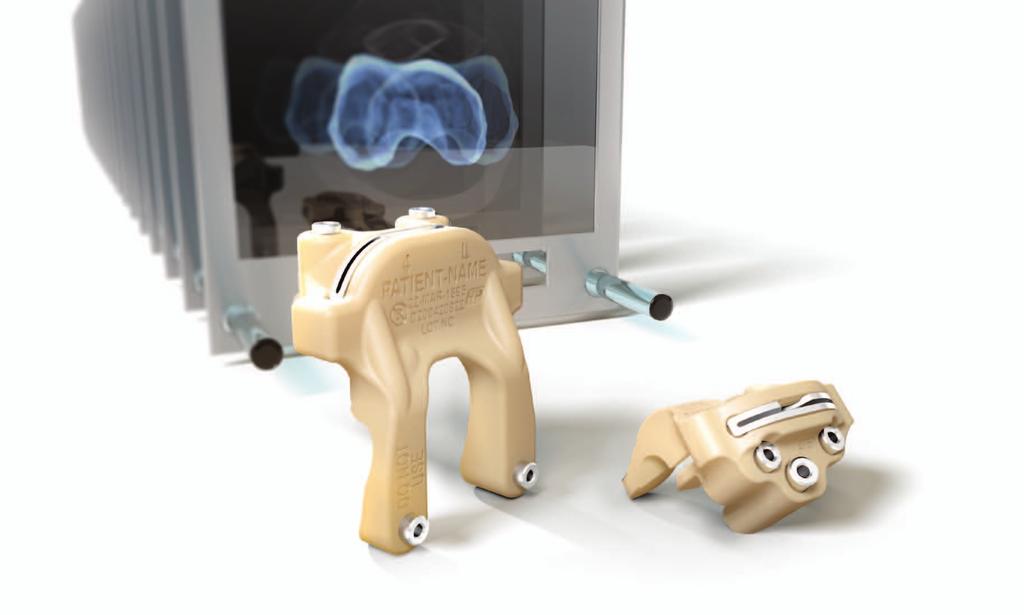 With a three-dimensional plan of the whole leg structure, the TRUMATCH Solutions team of engineers will model resection guides to provide mechanical alignment through the new total knee.