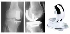 UNICOMPARTMENTAL KNEE PROSTHESIS SUMMARY: - Only medial or lateral compartment osteoarthritis - Stable ligaments - Shorter rehab than with total knee arthroplasty (TKA) - Osteoarthritis can go on ->