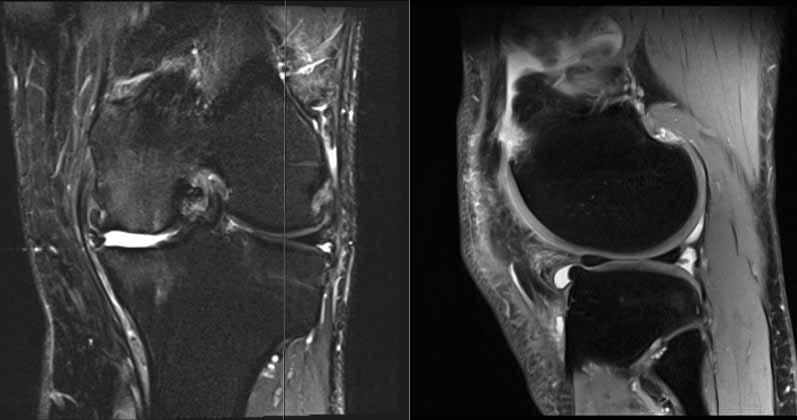 46 Y OLD MALE MRI for evaluation of the