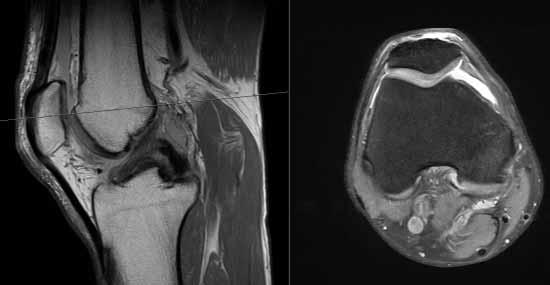 lateral and patellofemoral compartment