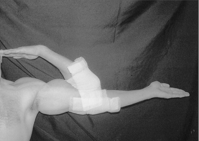 Jupiter et al. The Assessment and Management of the Stiff Elbow.