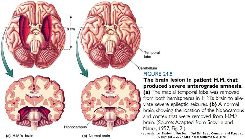 The Temporal Lobes and Declarative Memory