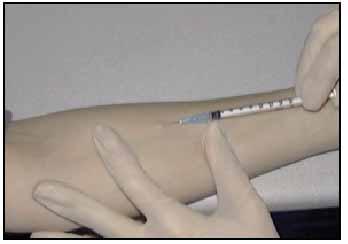 Figure: Administration of the tuberculin skin test using the Mantoux method Reading The results should be read between 48 and 72 hours after administration.