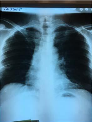 Case study 11 30 15 CT Chest: Acute LLL pneumonia with predominately posterior subpleural