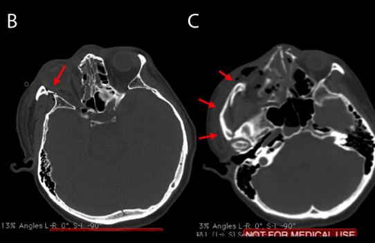 Axial CT scan (below) visualize clearly the displacement at the zygomaticosphenoid suture (B) and (C) zygomatic arch which will disturb the anteroposterior projection of the midface and facial width.