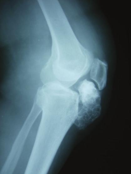 Plain radiographs of the knee revealed a mineralized mass situated between the anterior tibial tubercle and the patella. The mass appeared to occupy the entire region of the infrapatellar fat pad.