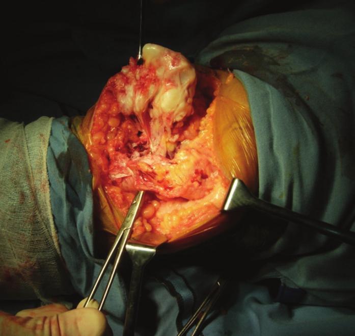 Case Reports in Orthopedics 3 Figure 4: Intraoperative findings. Tumour medial to the patellar tendon and tumour impaling medial femoral condyle. Figure 5: Excised mass in toto.