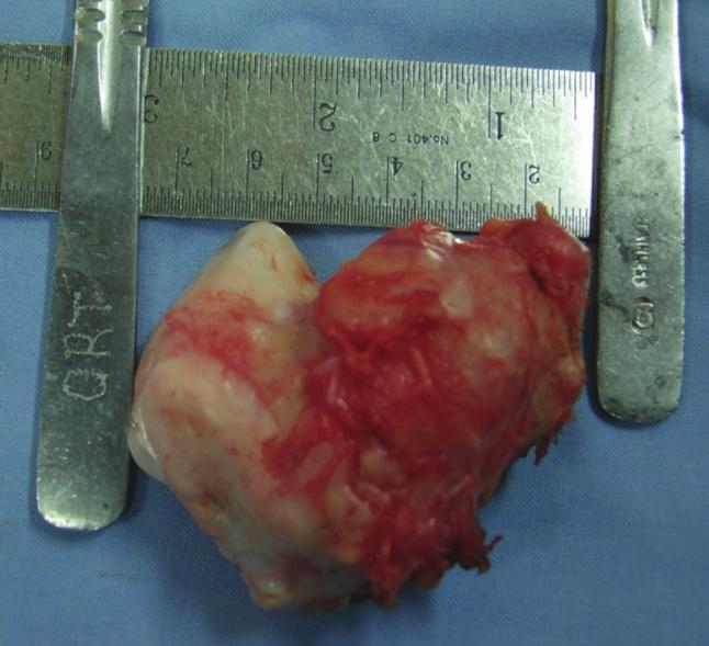 ossification of infrapatellar fat pad, and ossifying chondroma [4 14].